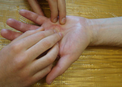 Narbenbehandlung in der Handtherapie & Handrehabilitation